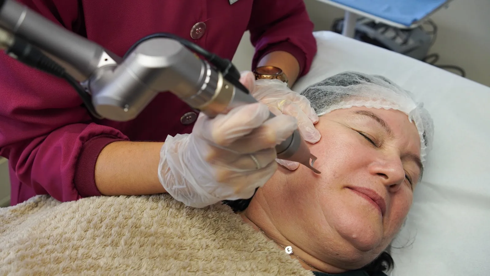 Aplicação de laser CO2 fracionado por dermatologista
