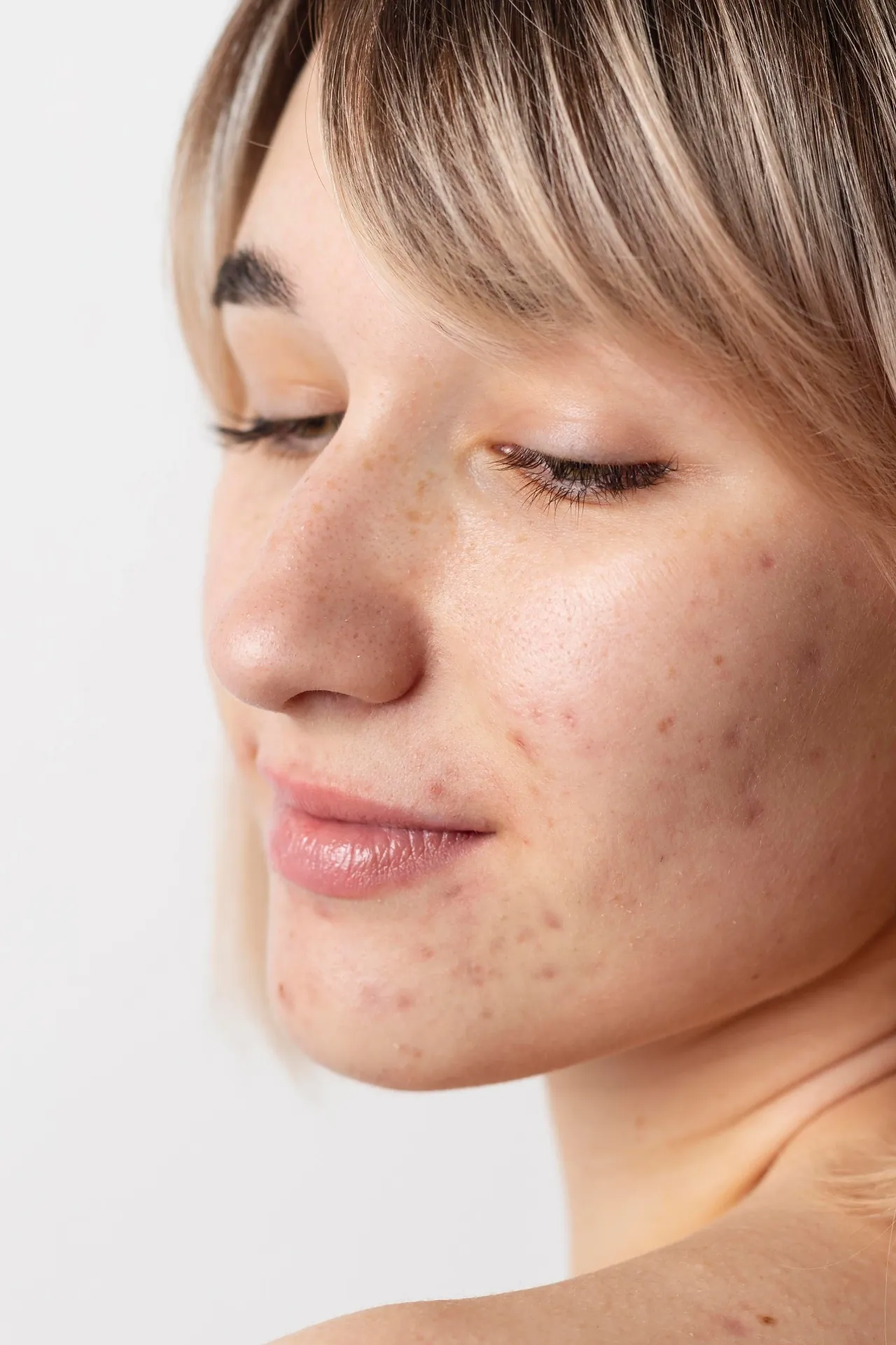 Mulher refletindo sobre as marcas deixadas pela acne